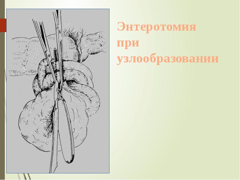 Энтеротомия при узлообразовании Энтеротомия при узлообразовании