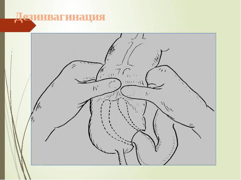 Дезинвагинация Дезинвагинация