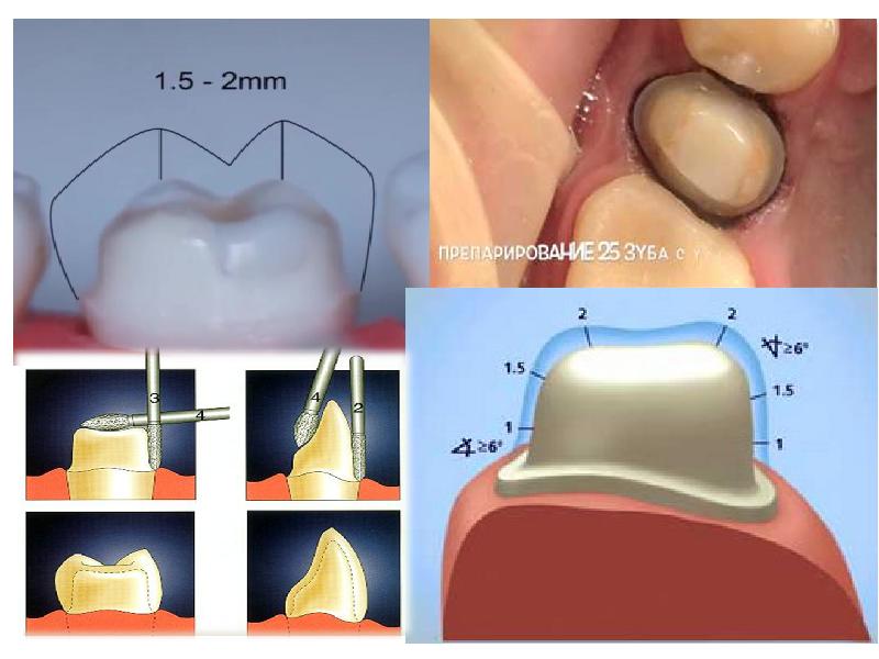 Препарирование под коронки презентация