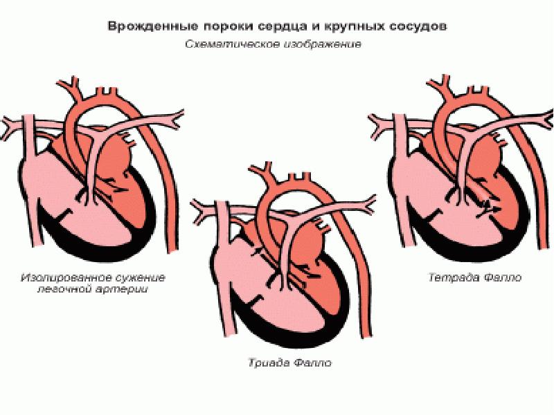 Как выглядит порок сердца на картинке