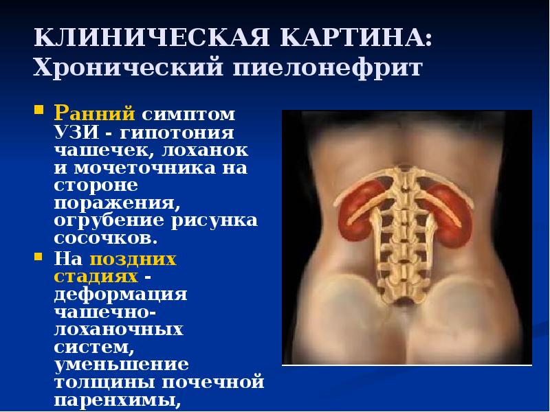 Презентация на тему цистит пиелонефрит