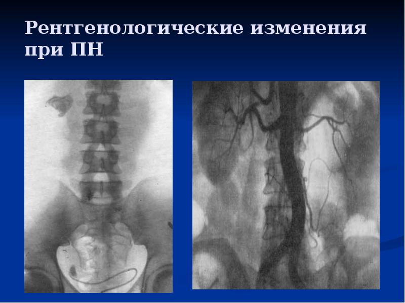 Презентация на тему цистит пиелонефрит