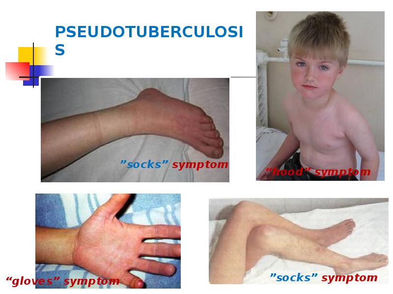 PSEUDOTUBERCULOSIS PSEUDOTUBERCULOSIS