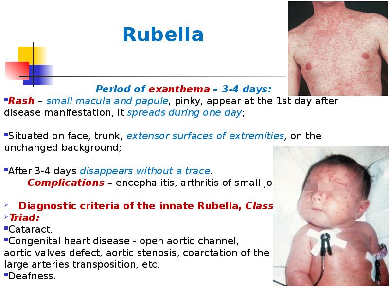 Rubella
Period of exanthema – 3-4 days:
Rash – small macula Rubella
Period of exanthema – 3-4 days:
Rash – small macula