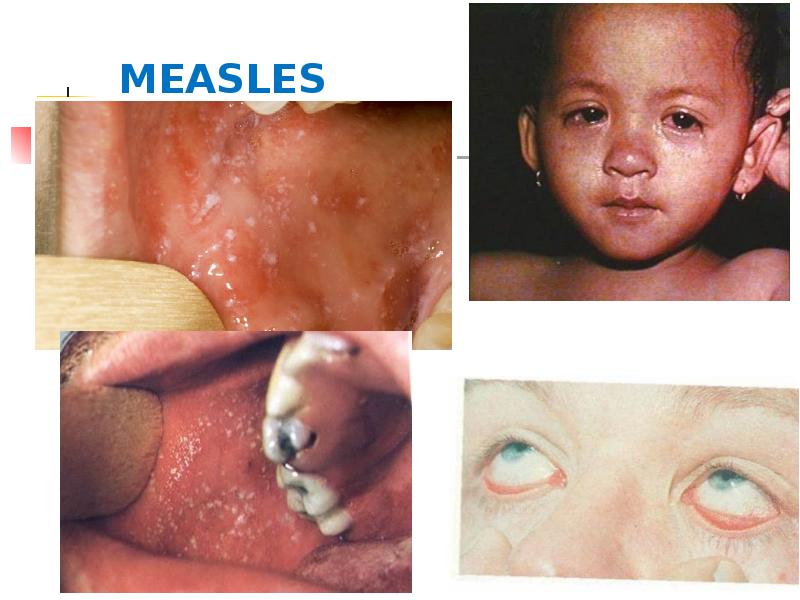 MEASLES MEASLES