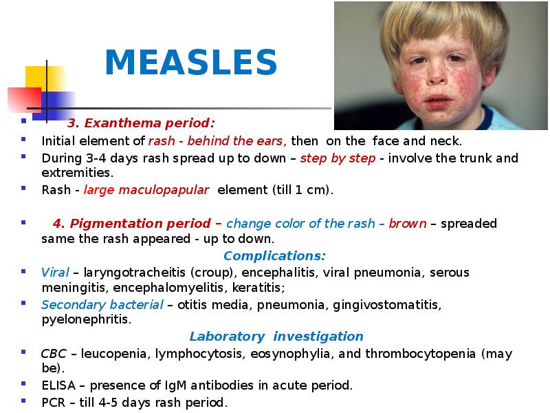 MEASLES
3. Exanthema period:
Initial element of MEASLES
3. Exanthema period:
Initial element of