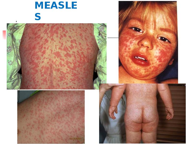 MEASLES MEASLES
