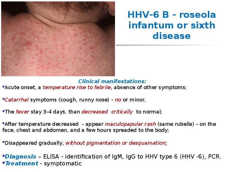 HHV-6 В - roseola infantum or sixth disease
Clinical manifestations:
Acute HHV-6 В - roseola infantum or sixth disease
Clinical manifestations:
Acute