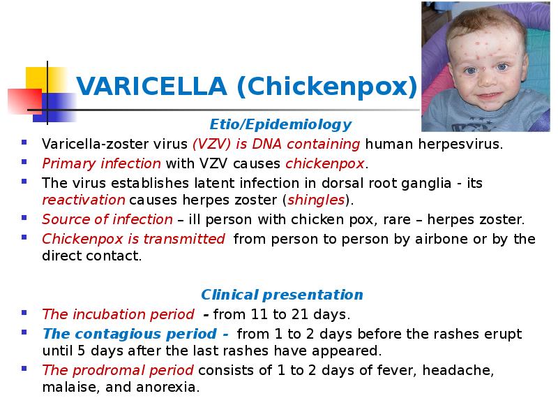 VARICELLA (Chickenpox)
Etio/Epidemiology
Varicella-zoster virus (VZV) is DNA containing human VARICELLA (Chickenpox)
Etio/Epidemiology
Varicella-zoster virus (VZV) is DNA containing human