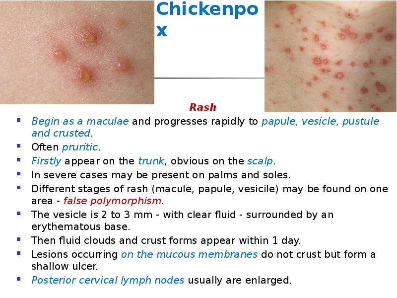 Chickenpox
Rash
Begin as a maculae and progresses rapidly to Chickenpox
Rash
Begin as a maculae and progresses rapidly to