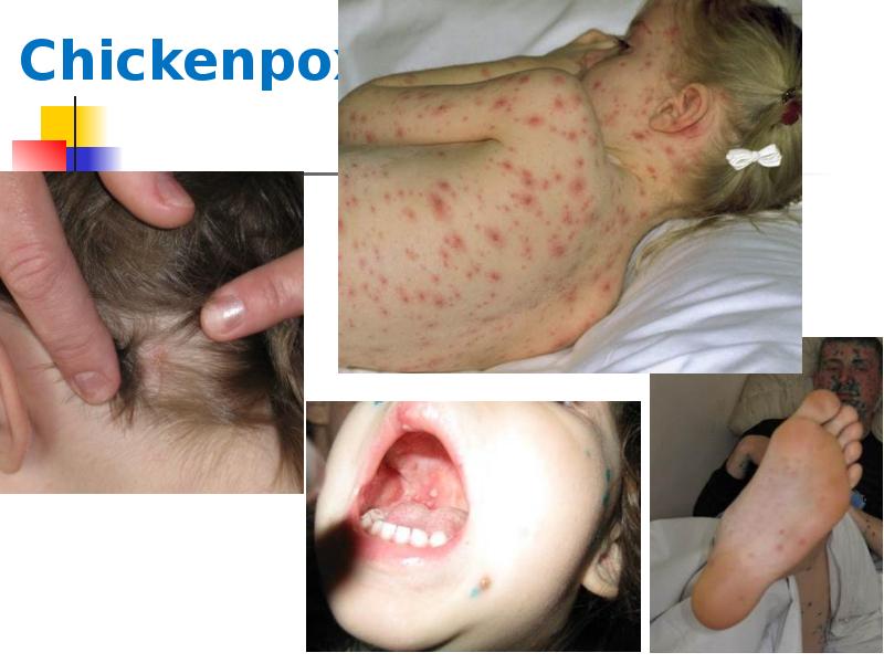 Chickenpox Chickenpox