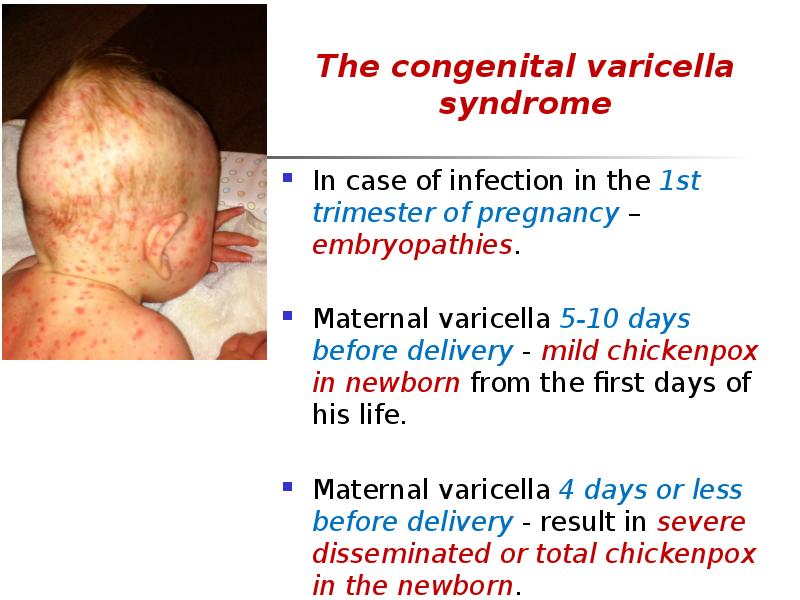 The congenital varicella syndrome
The congenital varicella syndrome
In case of The congenital varicella syndrome
The congenital varicella syndrome
In case of