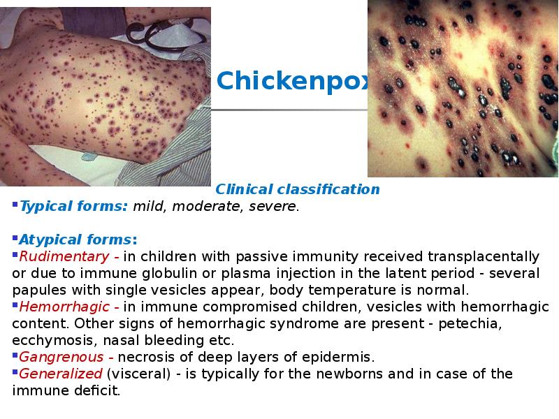 Chickenpox
Clinical classification
Typical forms: mild, moderate, Chickenpox
Clinical classification
Typical forms: mild, moderate,