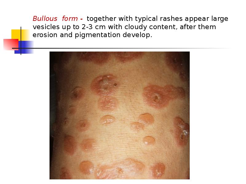 Bullous form - together with typical rashes appear large vesicles up Bullous form - together with typical rashes appear large vesicles up