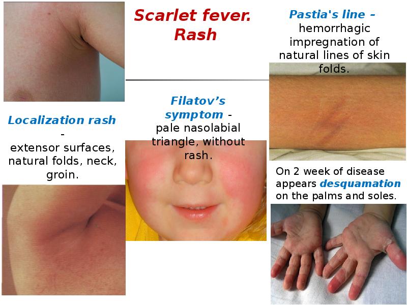 Scarlet fever. Rash Scarlet fever. Rash