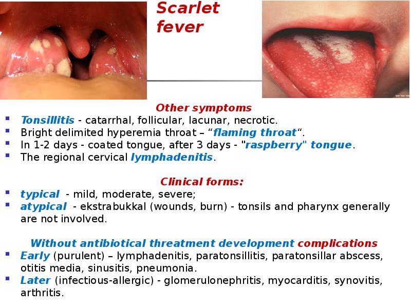 Scarlet fever
Other symptoms
Tonsillitis - catarrhal, follicular, lacunar, necrotic.
Bright Scarlet fever
Other symptoms
Tonsillitis - catarrhal, follicular, lacunar, necrotic.
Bright