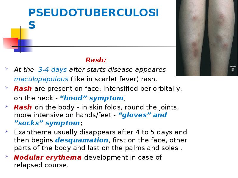 PSEUDOTUBERCULOSIS
Rash:
At the 3-4 days after starts disease appeares maculopapulous PSEUDOTUBERCULOSIS
Rash:
At the 3-4 days after starts disease appeares maculopapulous