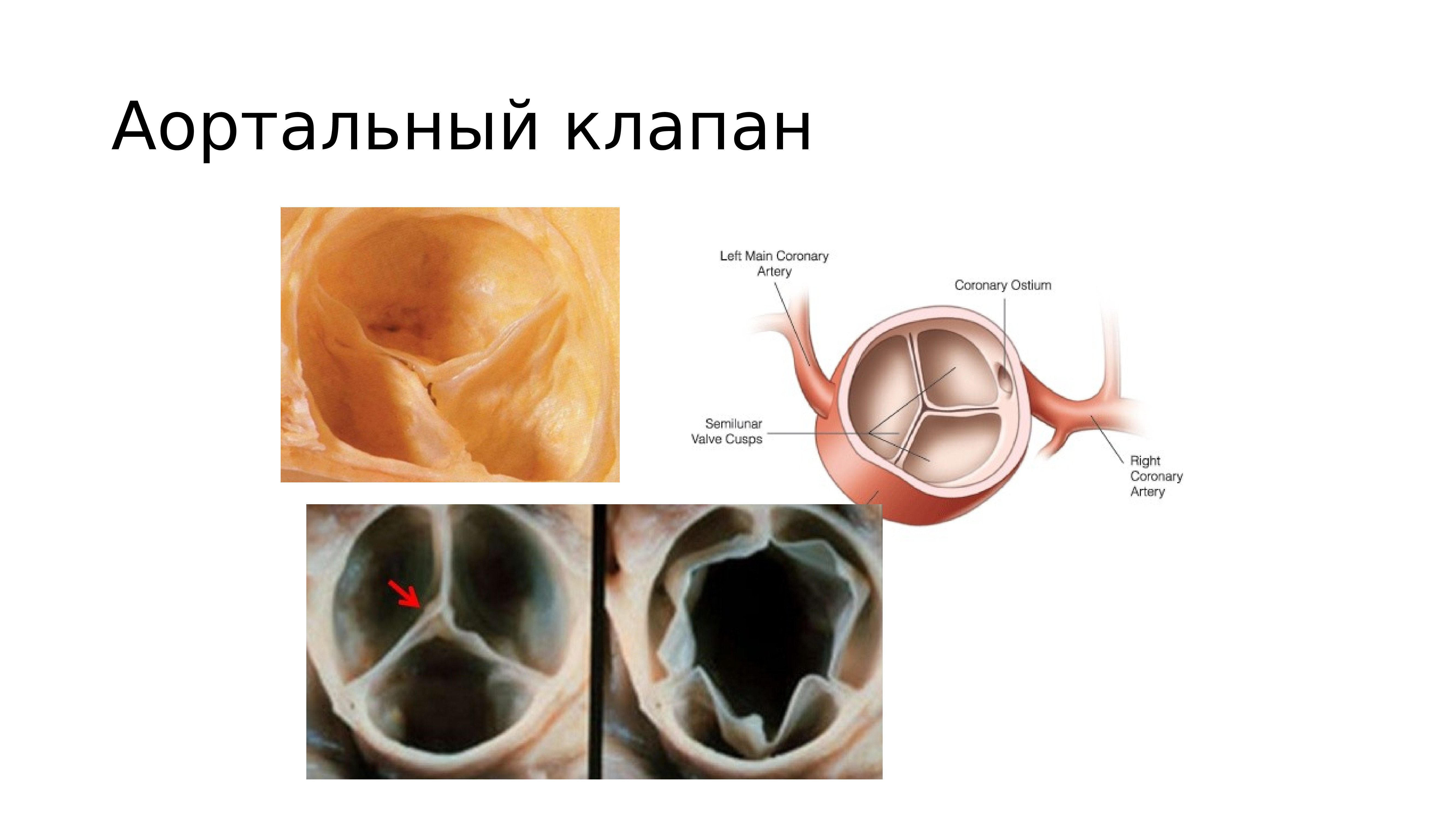 Аортальный клапан сердца. Створки аортального клапана анатомия. Аортальный клапан 3 створчатый. Клапан сердца порок двухстворчатый аортальный клапан. Створки аортального клапана двустворчатого.