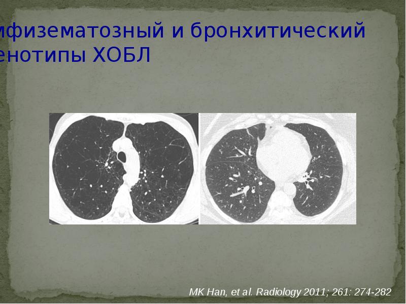 Рентгенологическая картина при хобл