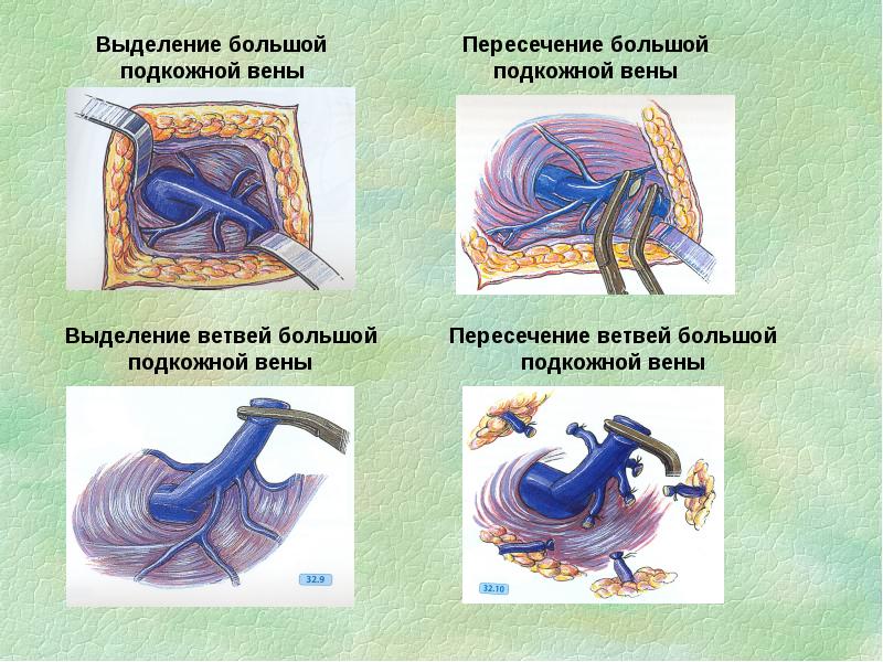 Операции на нервах сухожилиях. Выделение большой подкожной вены. Пересечение и перевязка малой подкожной вены. Оперативные вмешательства на нервах.