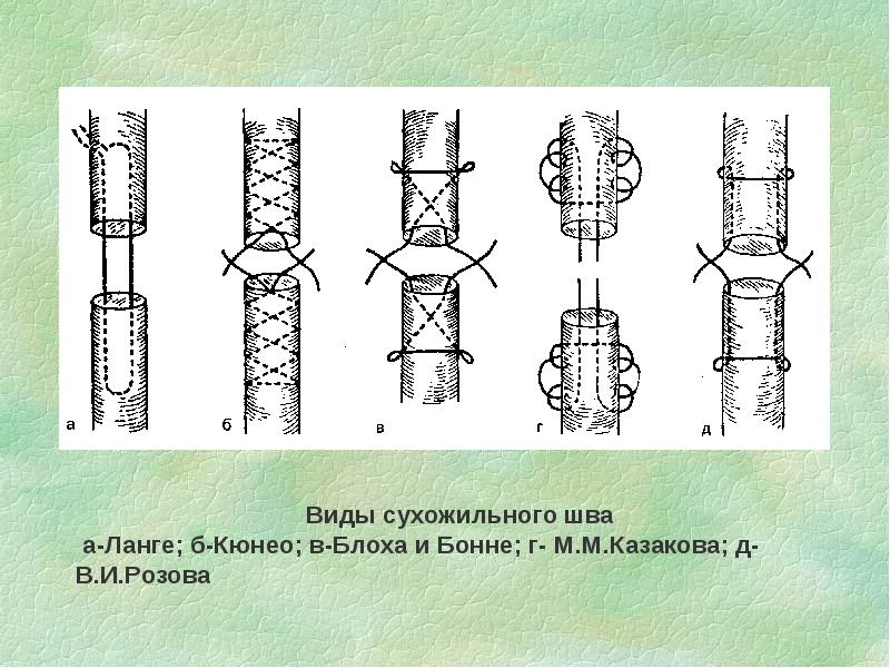 Виды сухожильного шва а-Ланге; б-Кюнео; в-Блоха и Бонне; г- М.М.Казакова; Виды сухожильного шва а-Ланге; б-Кюнео; в-Блоха и Бонне; г- М.М.Казакова;