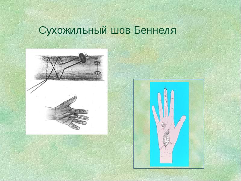 Сухожильный шов Беннеля