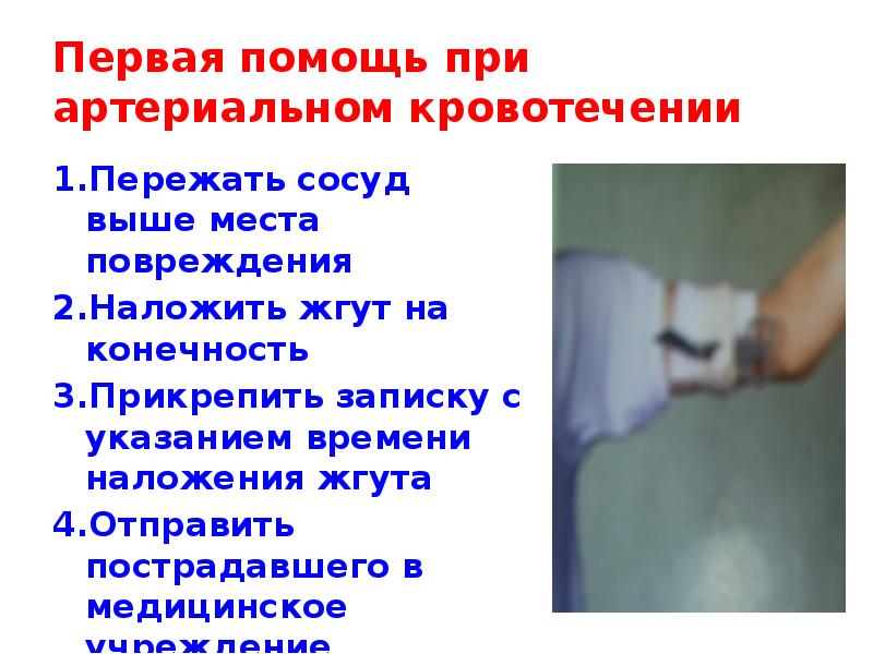 Первая помощь при артериальном кровотечении 1.Пережать сосуд выше места повреждения 2.Наложить