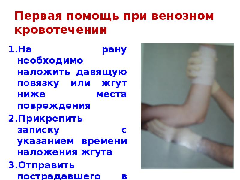 Первая помощь при венозном кровотечении 1.На рану необходимо наложить давящую повязку
