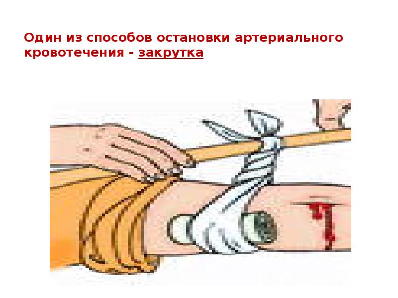 Один из способов остановки артериального кровотечения - закрутка