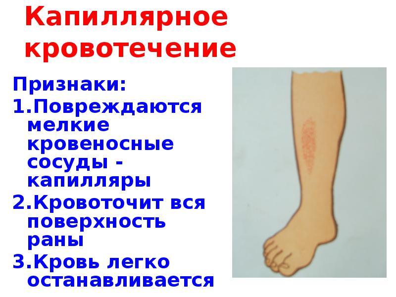 Капиллярное кровотечение Признаки: 1.Повреждаются мелкие кровеносные сосуды - капилляры 2.Кровоточит вся