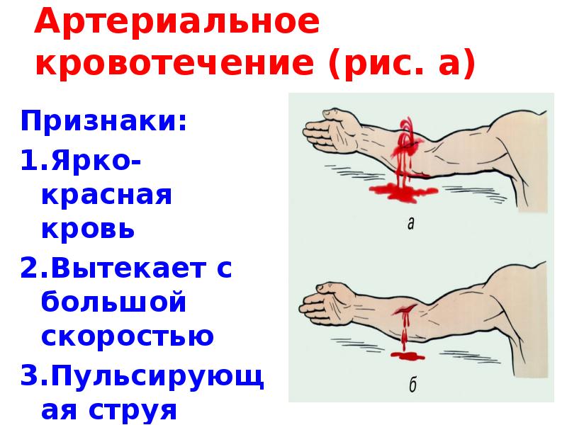 Артериальное кровотечение (рис. а)  Признаки: 1.Ярко-красная кровь 2.Вытекает с большой