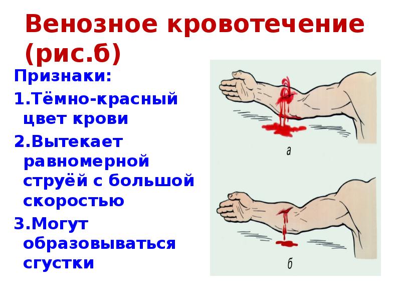 Венозное кровотечение (рис.б) Признаки: 1.Тёмно-красный цвет крови 2.Вытекает равномерной струёй с