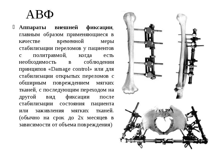 Перелом кости голени мкб 10