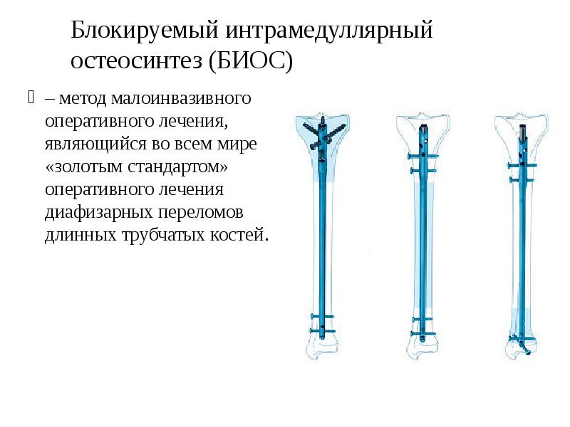 Переломы длинных трубчатых костей презентация