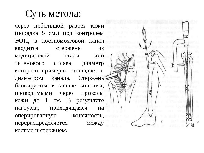 Переломы хирургия презентация