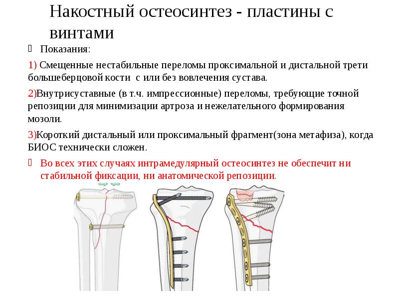 Переломы хирургия презентация