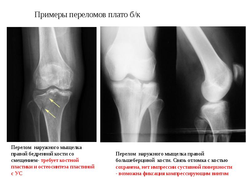 Перелом голени презентация