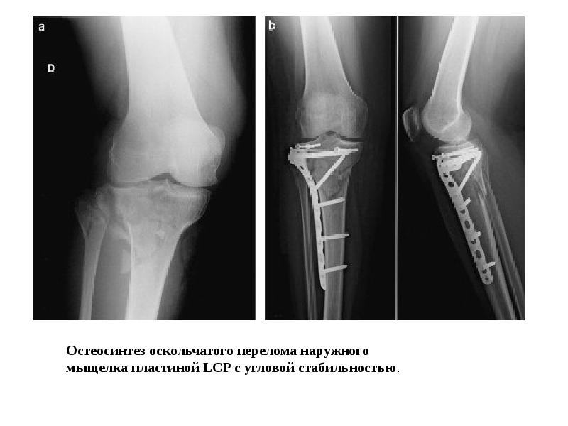 Перелом голени презентация