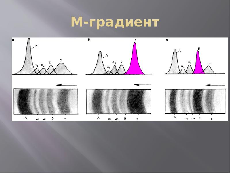 М градиент при миеломной. М градиент протеинограмма. Белковые фракции м градиент. М градиент норма.