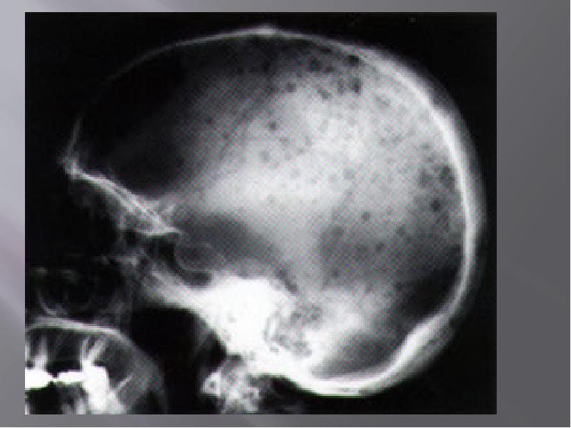 миеломная болезнь костей черепа рентген. миеломная болезнь рентген черепа. деструкция кости черепа. миеломная болезнь кости черепа рентген. миеломная болезнь костей черепа.
