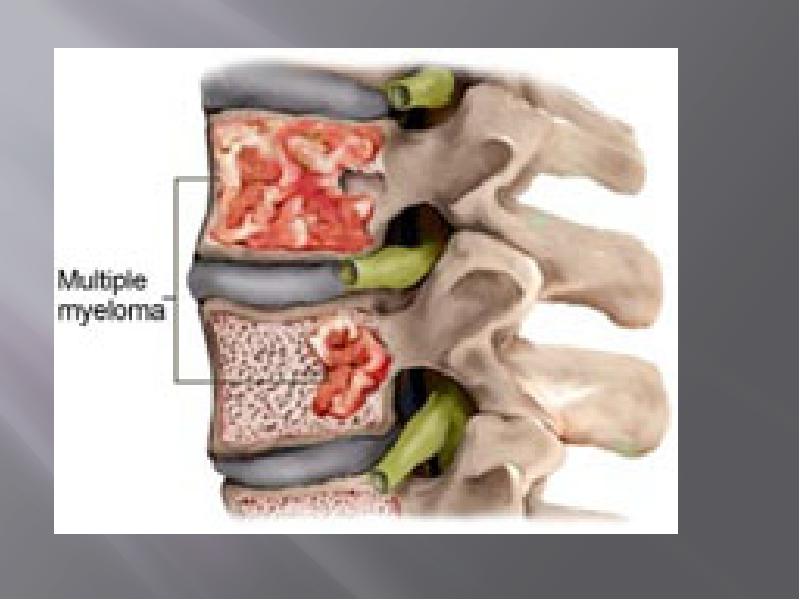 Миеломная болезнь костный мозг. Множественная миелома позвоночник. Миеломная болезнь костей позвоночника. Опухоль на позвоночнике при множественной миеломе.
