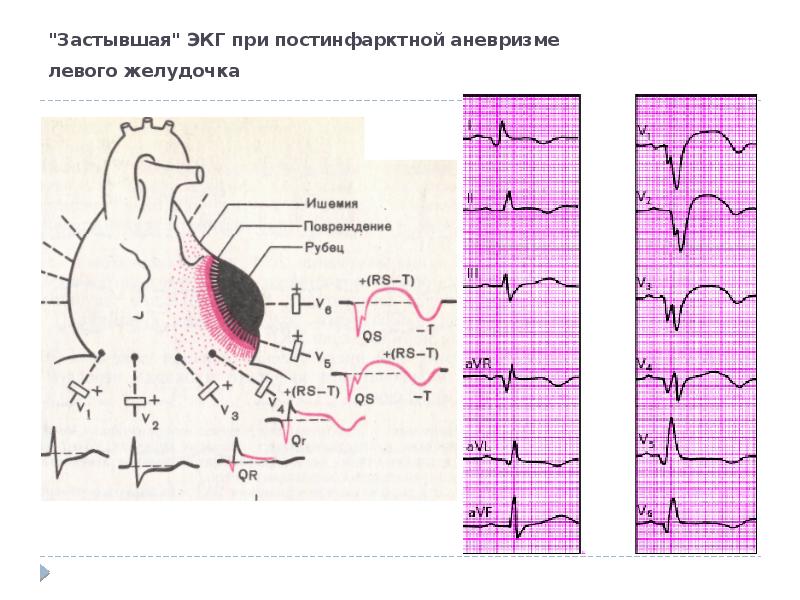 Пикс по передней стенке