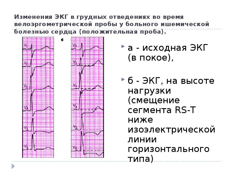 Передняя стенка на экг какие отведения