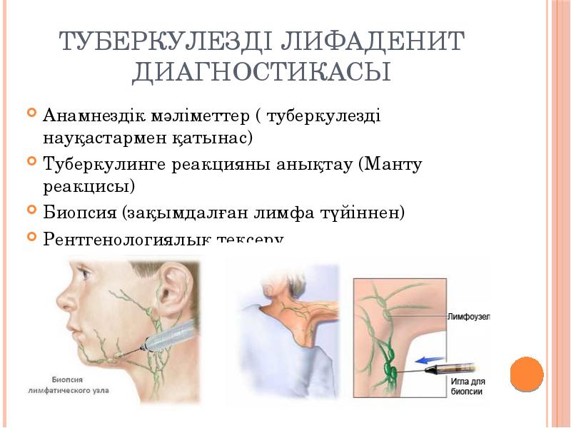 Туберкулезді лимфаденит презентация