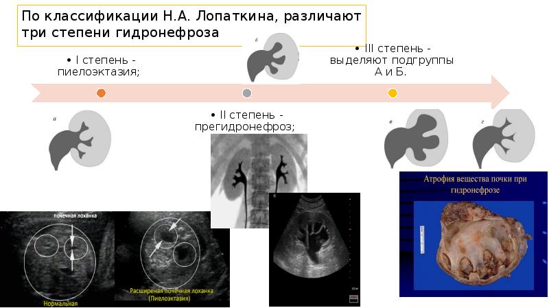 Гидронефроз у детей презентация