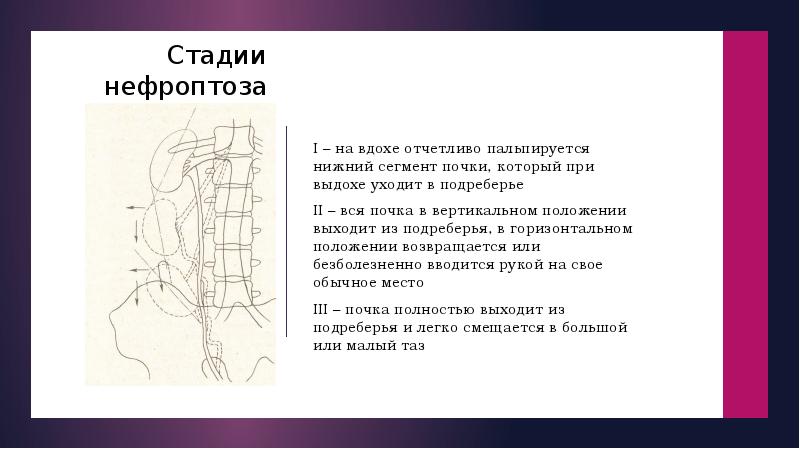 Нефроптоз код. Нефроптоз почки 1 степени. Стадии нефроптоза. Степени нефроптоза по УЗИ. Нефроптоз 1 степени УЗИ.