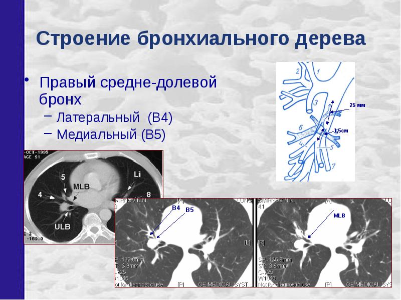 Бронхи на кт схема