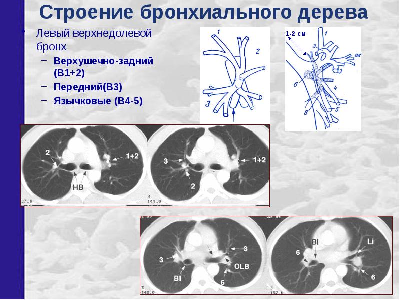 Бронхи на кт схема