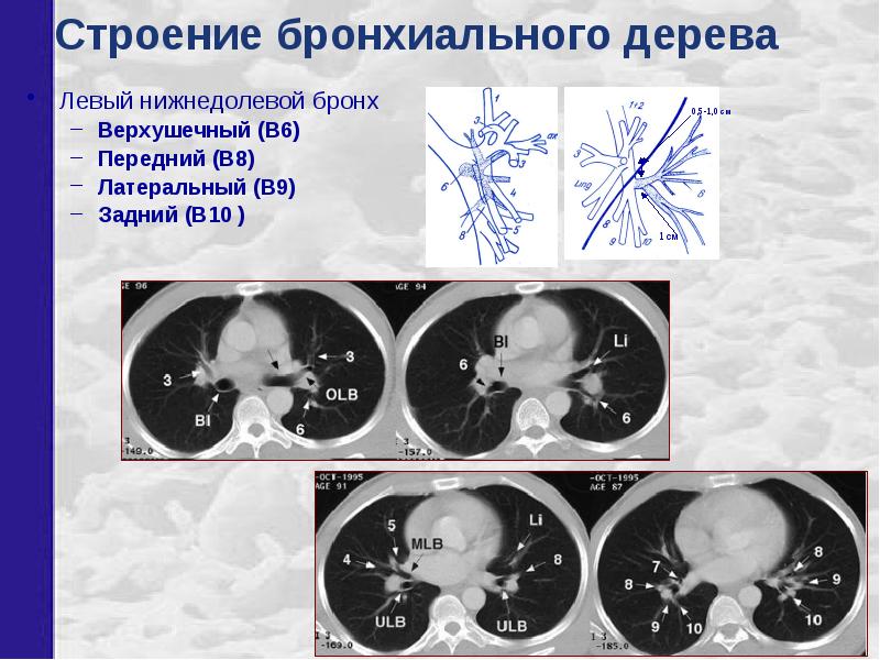 Бронхи схема кт