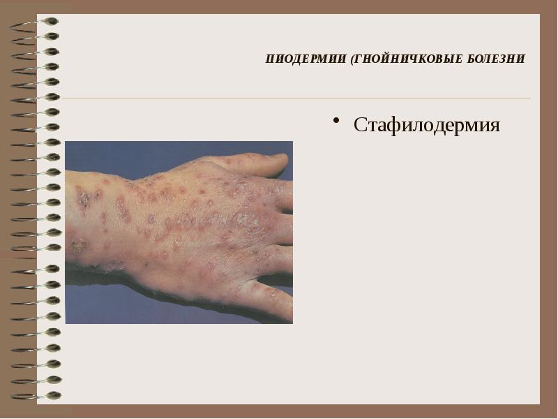 Гнойничковые заболевания кожи презентация